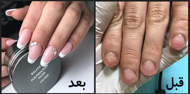 قبل و بعد کاشت ناخن